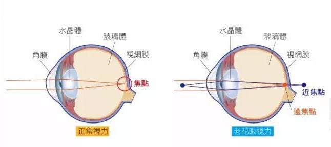 白內障和老花眼區別，老花眼發(fā)病率正呈現年輕化趨勢